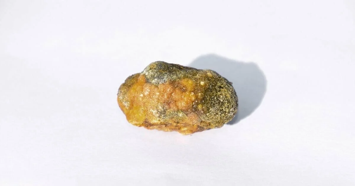 gallbladder stone