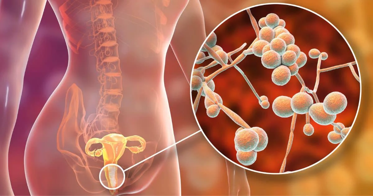 Candida overgrowth from a functional medicine perspective